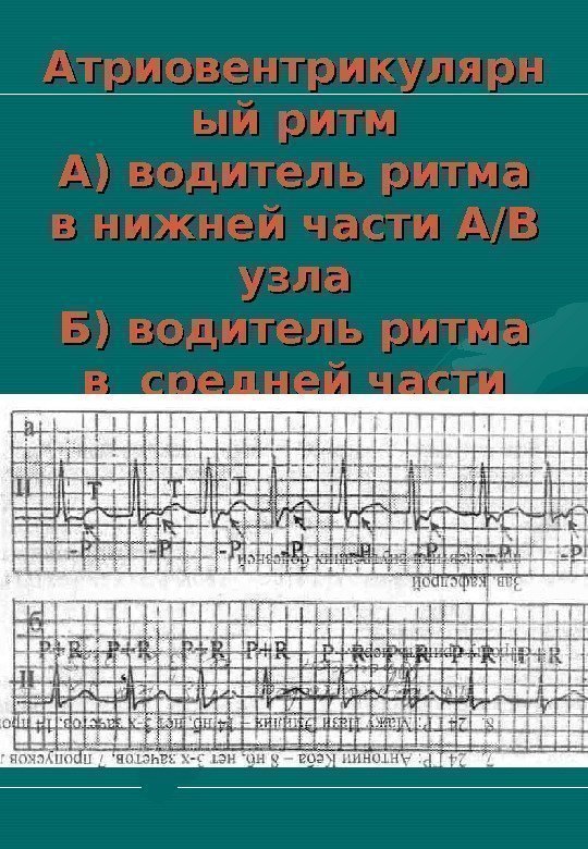   Атриовентрикулярн ый ритм А) водитель ритма в нижней части А/В узла Б)