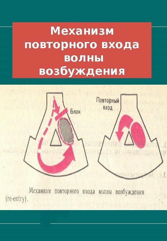   Механизм повторного входа  волны возбуждения 