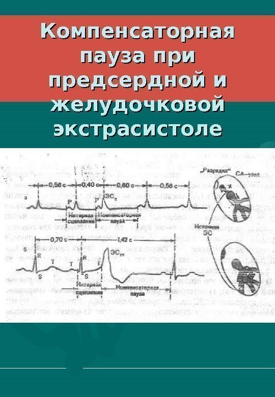   Компенсаторная пауза при предсердной и желудочковой экстрасистоле 