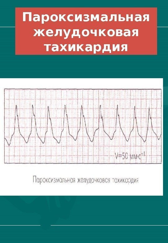   Пароксизмальная желудочковая тахикардия 