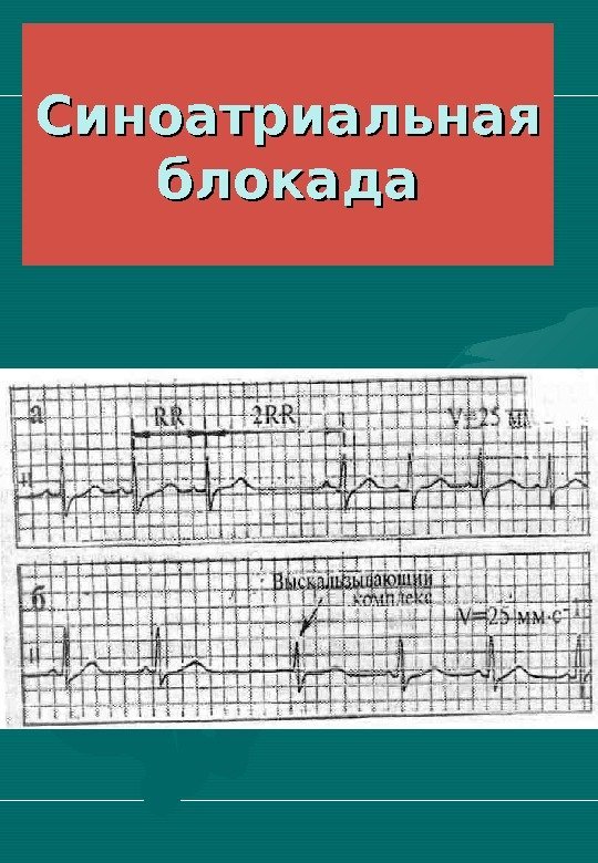   Синоатриальная блокада 