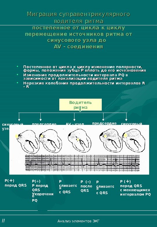   Миграция суправентрикулярного водителя ритма постепенное от цикла к циклу перемещение источников ритма
