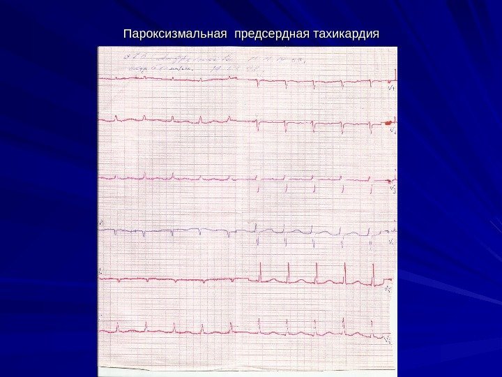 Пароксизмальная предсердная тахикардия 