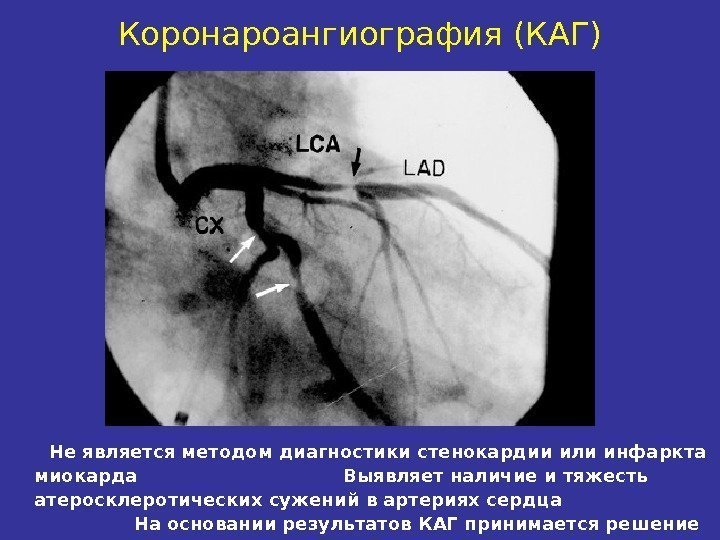 Коронароангиография (КАГ)  Не является методом диагностики стенокардии или инфаркта миокарда   
