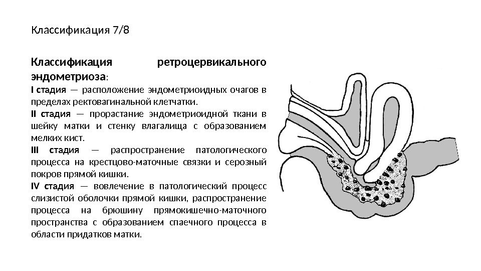 Классификация 7/8 Классификация ретроцервикального эндометриоза : I стадия  — расположение эндометриоидных очагов в