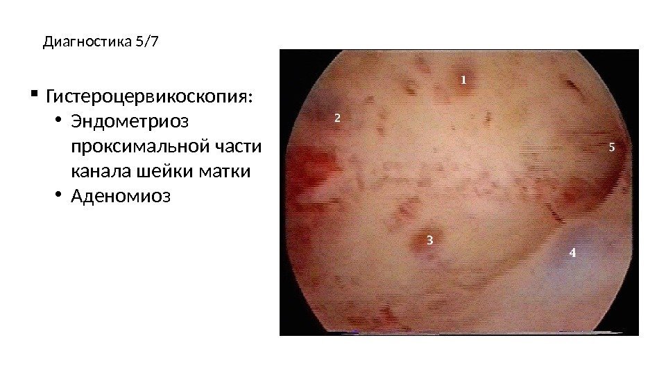  Гистероцервикоскопия:  • Эндометриоз проксимальной части канала шейки матки • Аденомиоз. Диагностика 5/7