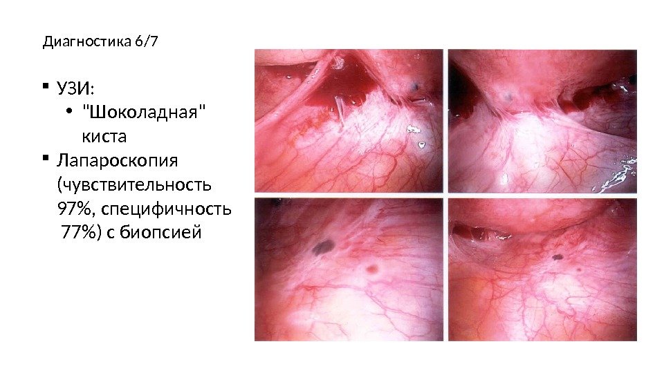  УЗИ:  • Шоколадная киста Лапароскопия  (чувствительность 97, специфичность  77) с