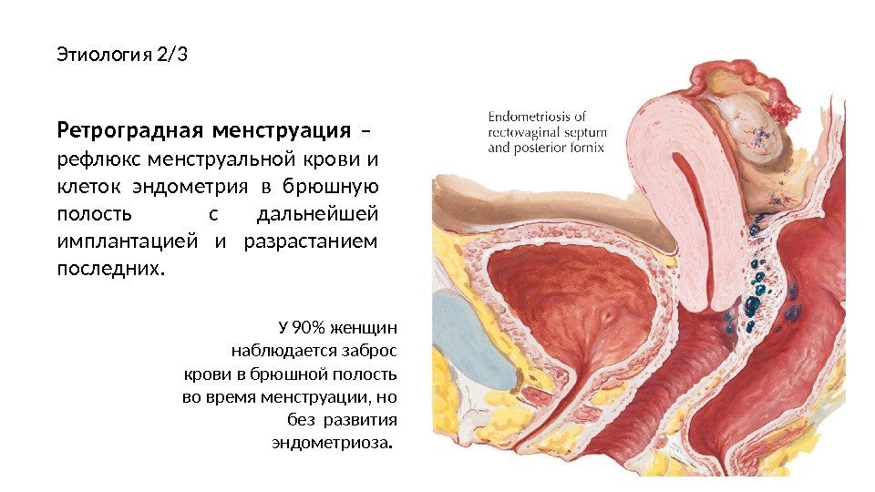 Этиология 2/3 Ретроградная менструация  –  рефлюкс менструальной крови и клеток эндометрия в