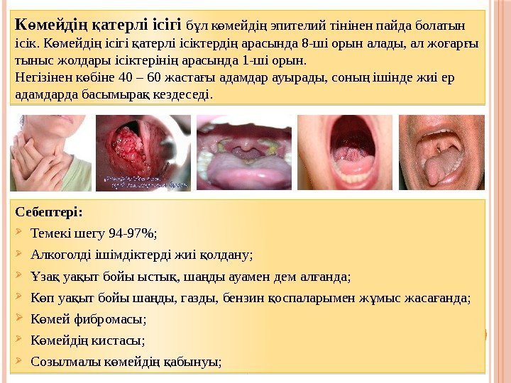 Себептері:  Темекі шегу 94 -97;  Алкоголді ішімдіктерді жиі олдану; қ за уа