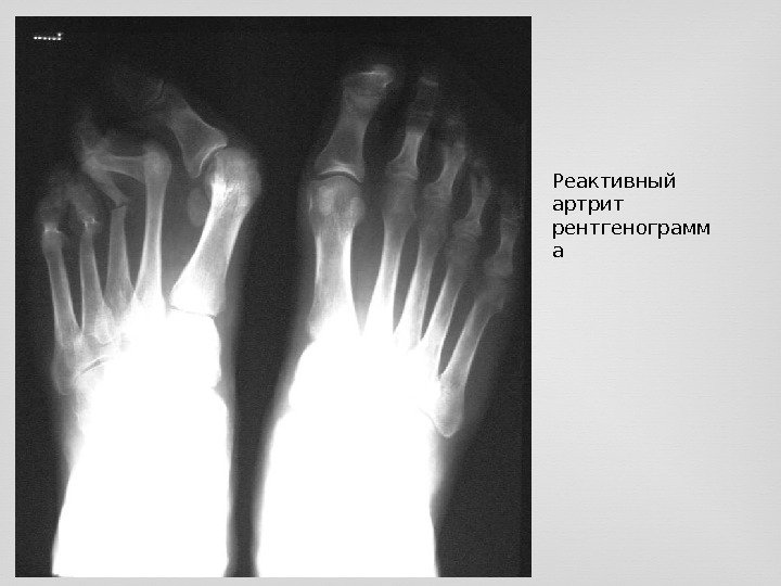 Реактивный артрит рентгенограмм а 