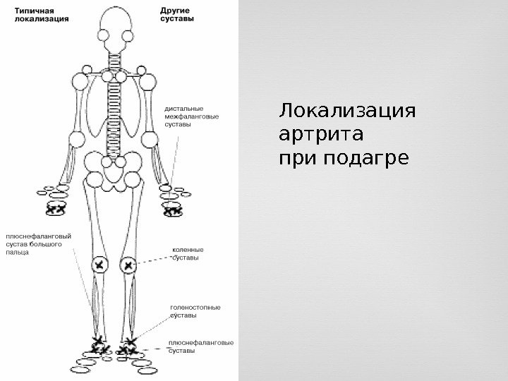 Локализация артрита при подагре 