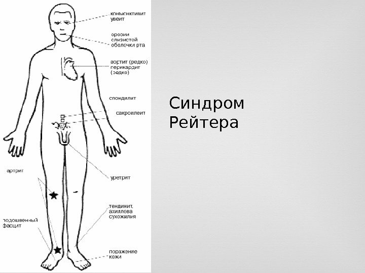 Синдром Рейтера 