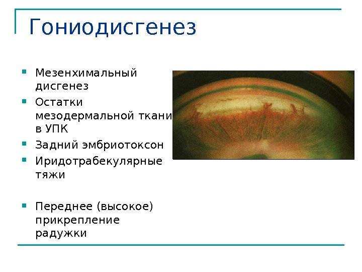  Гониодисгенез  Мезенхимальный дисгенез Остатки мезодермальной ткани в УПК Задний эмбриотоксон Иридотрабекулярные тяжи