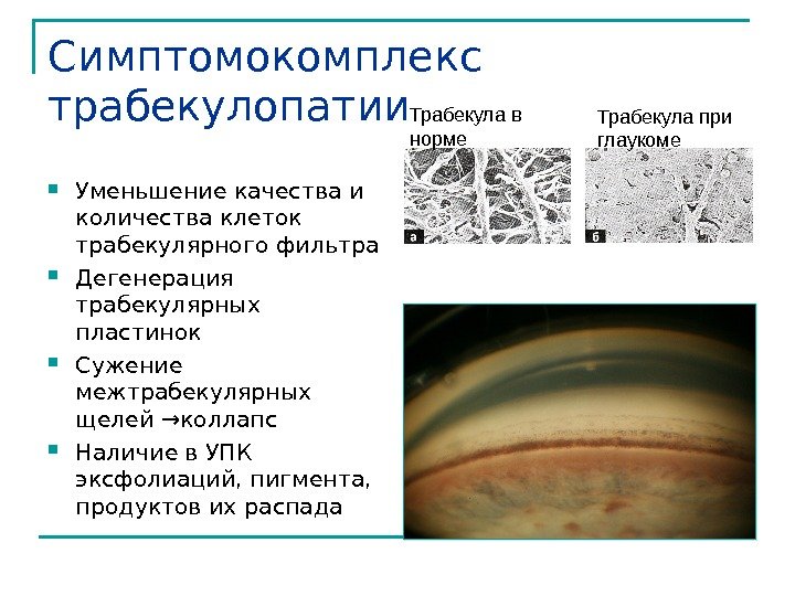 Симптомокомплекс трабекулопатии Уменьшение качества и количества клеток трабекулярного фильтра Дегенерация трабекулярных пластинок Сужение межтрабекулярных