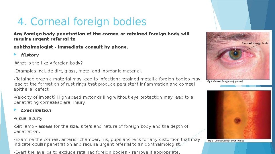 4. Corneal foreign bodies Any foreign body penetration of the cornea or retained foreign