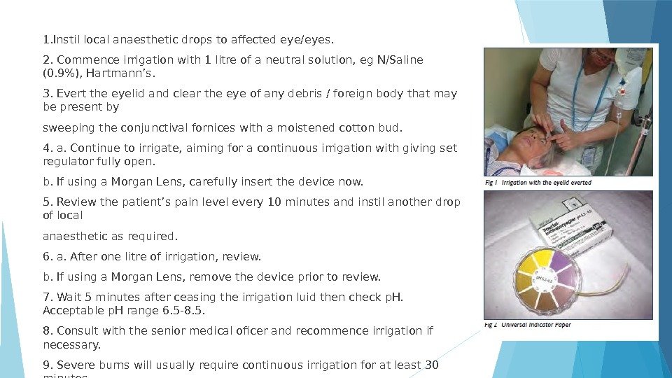 1. Instil local anaesthetic drops to affected eye/eyes. 2. Commence irrigation with 1 litre