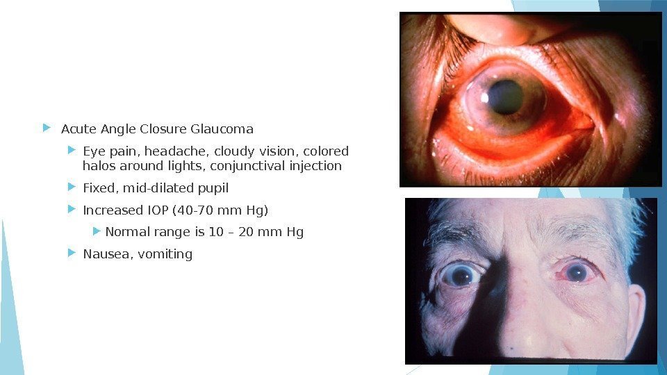  Acute Angle Closure Glaucoma Eye pain, headache, cloudy vision, colored halos around lights,