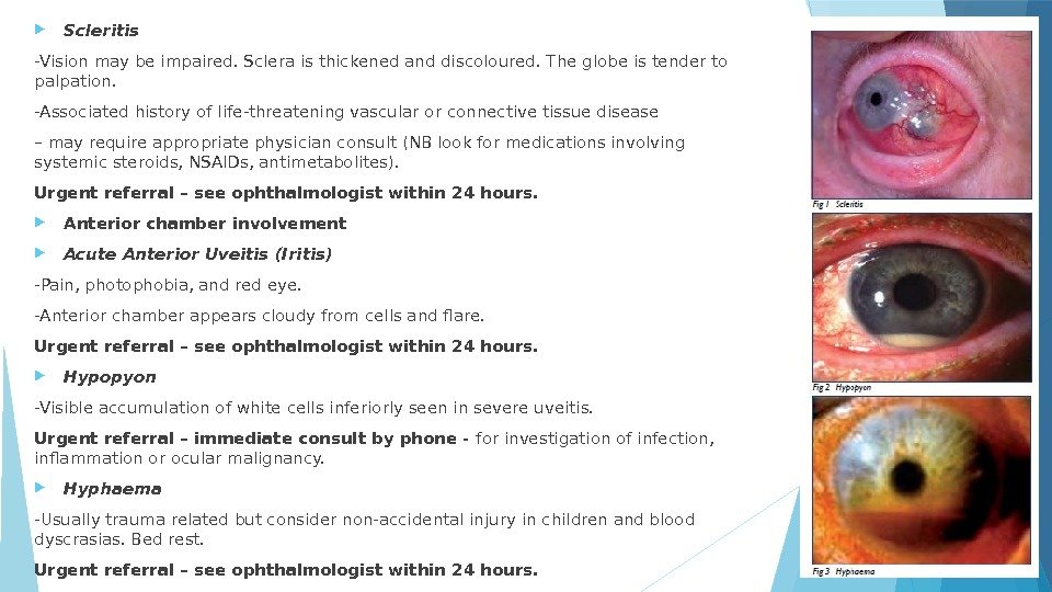  Scleritis -Vision may be impaired. Sclera is thickened and discoloured. The globe is
