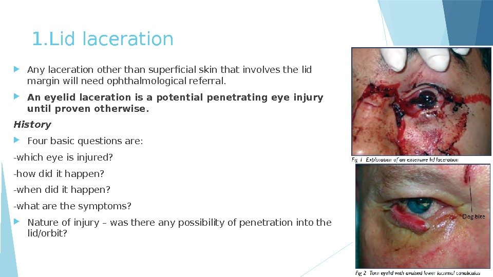 1. Lid laceration Any laceration other than superficial skin that involves the lid margin