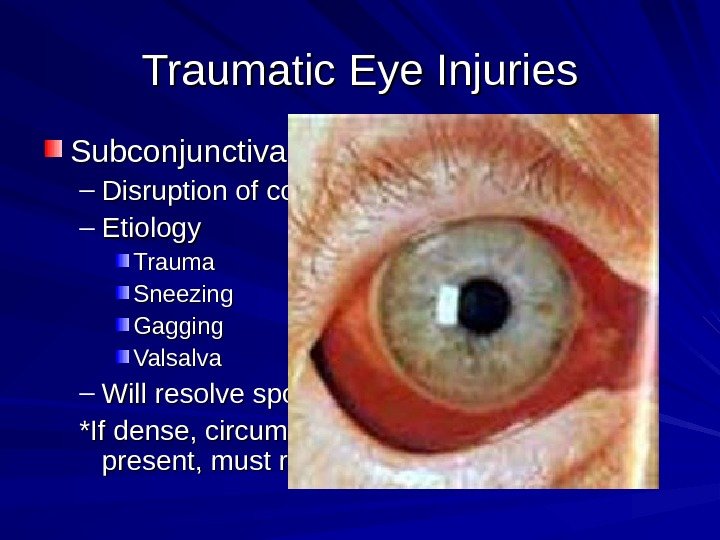 Traumatic Eye Injuries Subconjunctival Hemorrhage – Disruption of conjunctival blood vessel – Etiology Trauma