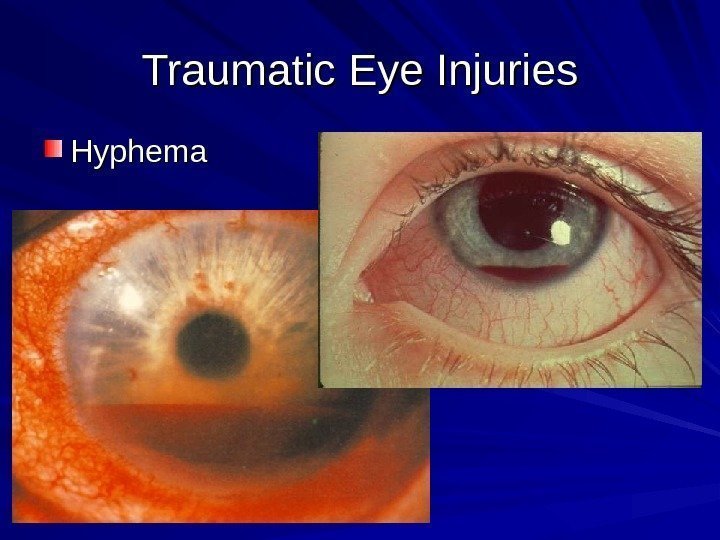 Traumatic Eye Injuries Hyphema 