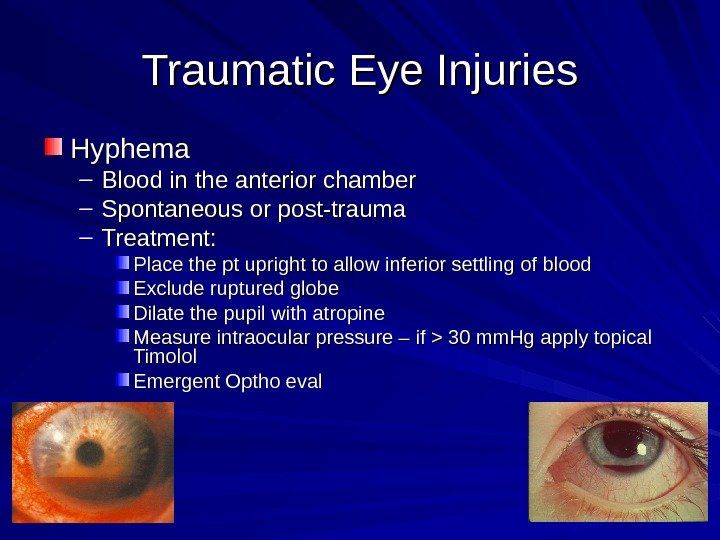 Traumatic Eye Injuries Hyphema – Blood in the anterior chamber – Spontaneous or post-trauma