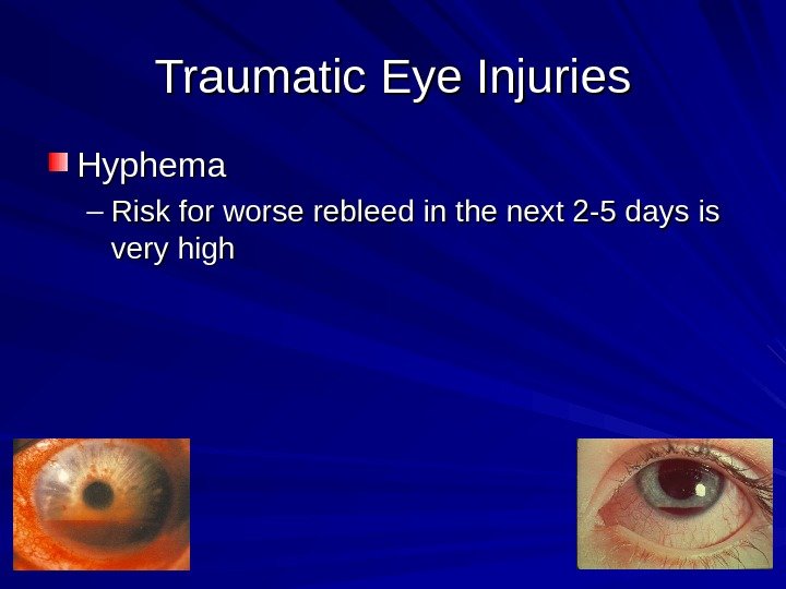 Traumatic Eye Injuries Hyphema – Risk for worse rebleed in the next 2 -5