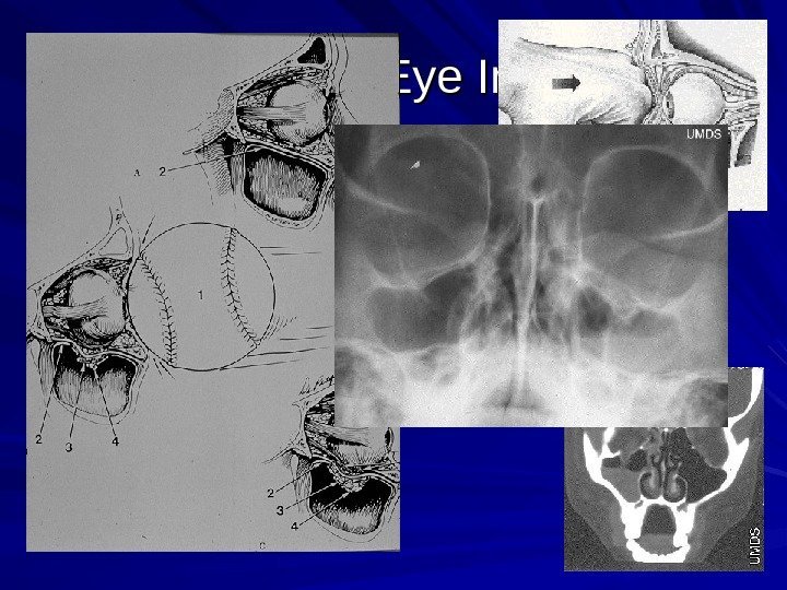 Traumatic Eye Injuries Blowout Fractures 