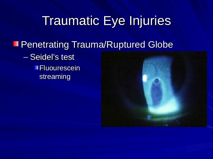 Traumatic Eye Injuries Penetrating Trauma/Ruptured Globe – Seidel’s test Fluourescein streaming 