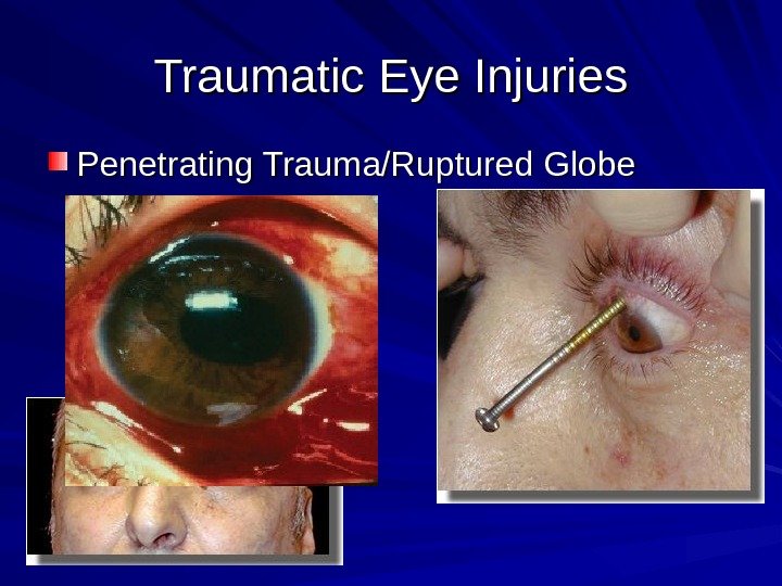 Traumatic Eye Injuries Penetrating Trauma/Ruptured Globe 