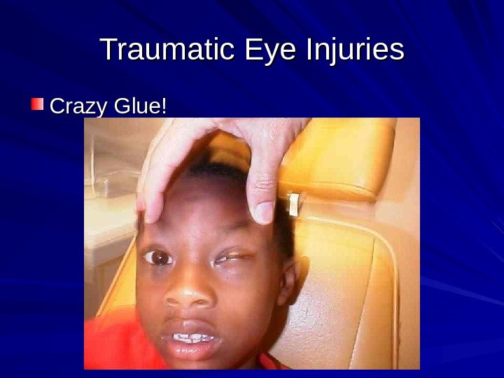 Traumatic Eye Injuries Crazy Glue! 