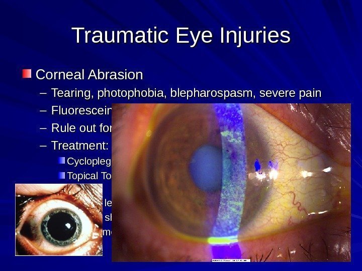 Traumatic Eye Injuries Corneal Abrasion – Tearing, photophobia, blepharospasm, severe pain – Fluorescein: dye