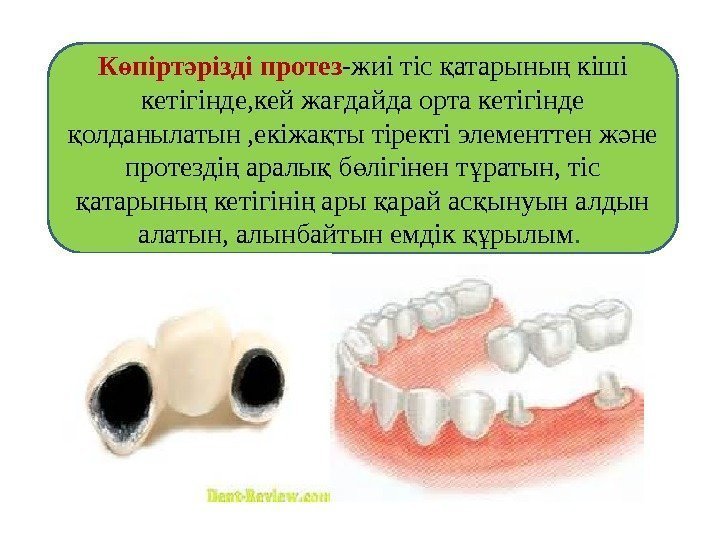 К пірт різді протезө ә -жиі тіс атарыны кіші қ ң кетігінде, кей жа