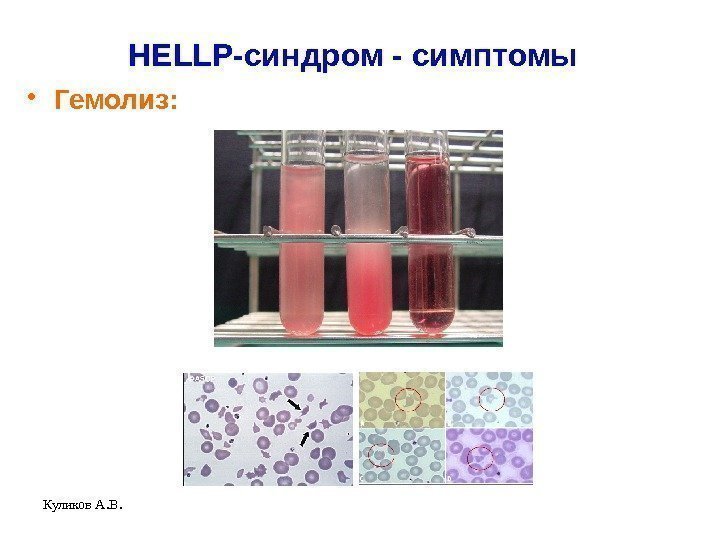 Куликов А. В. HELLP-синдром - симптомы • Гемолиз:  