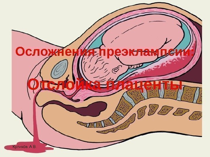 Осложнения преэклампсии: Отслойка плаценты Куликов А. В. 