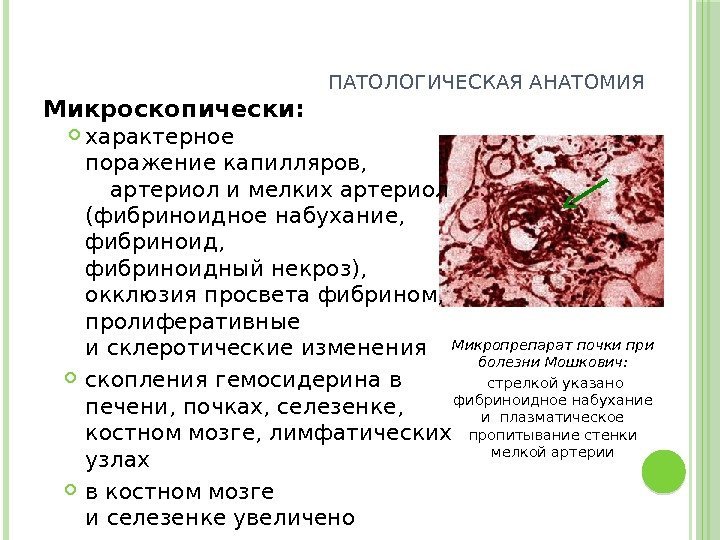 ПАТОЛОГИЧЕСКАЯ АНАТОМИЯ Микроскопически:  характерное поражениекапилляров,   артериоли мелких артериол (фибриноидное набухание, 