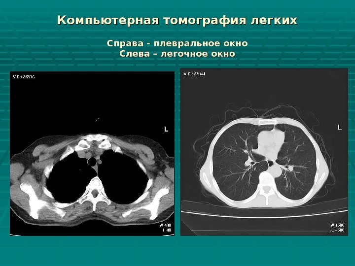 Компьютерная томография легких  Справа - плевральное окно Слева – легочное окно 