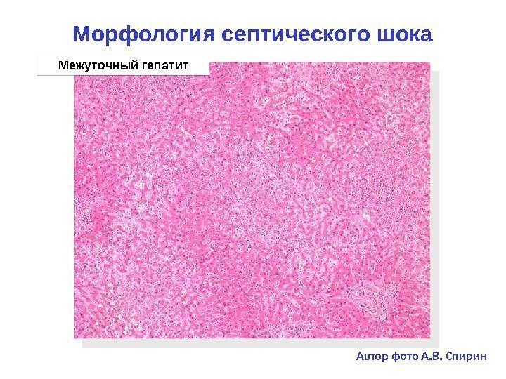Морфология септического шока Межуточный гепатит Автор фото А. В. Спирин 2 F 06 