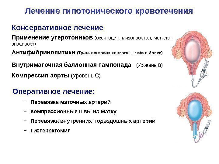 Лечение гипотонического кровотечения Консервативное лечение Применение утеротоников (окситоцин, мизопростол, метилэргометрин,  энзапрост) Антифибринолитики 