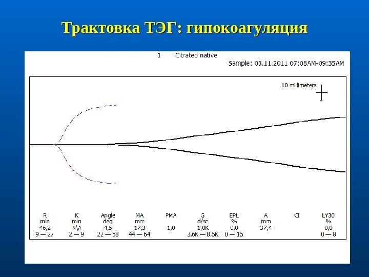 Трактовка ТЭГ: гипокоагуляция 