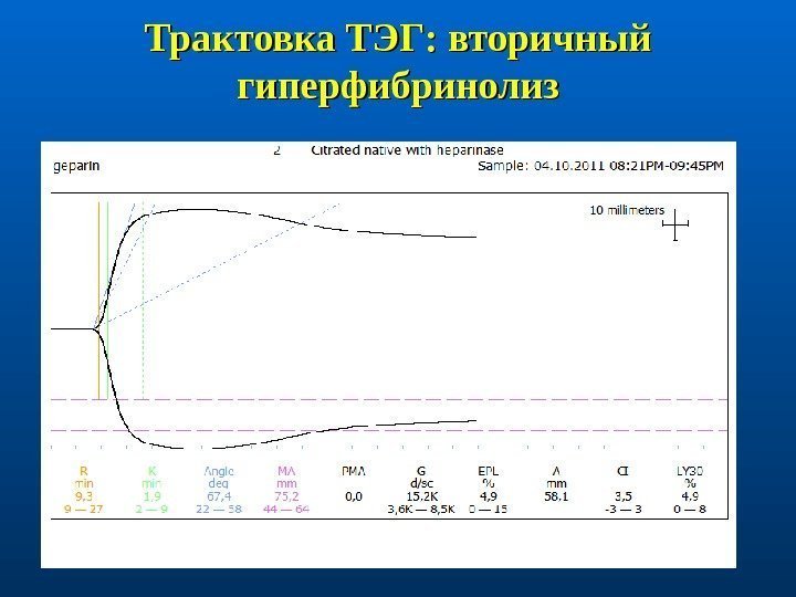 Трактовка ТЭГ: вторичный гиперфибринолиз 