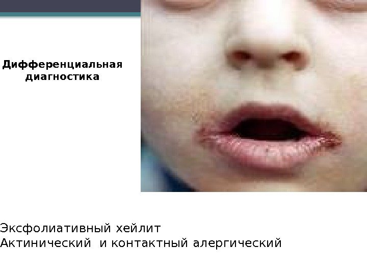  Эксфолиативный хейлит Актинический и контактный алергический Дифференциальная диагностика     