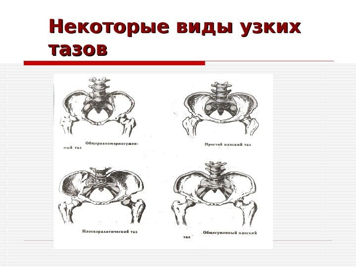 Некоторые виды узких тазов 