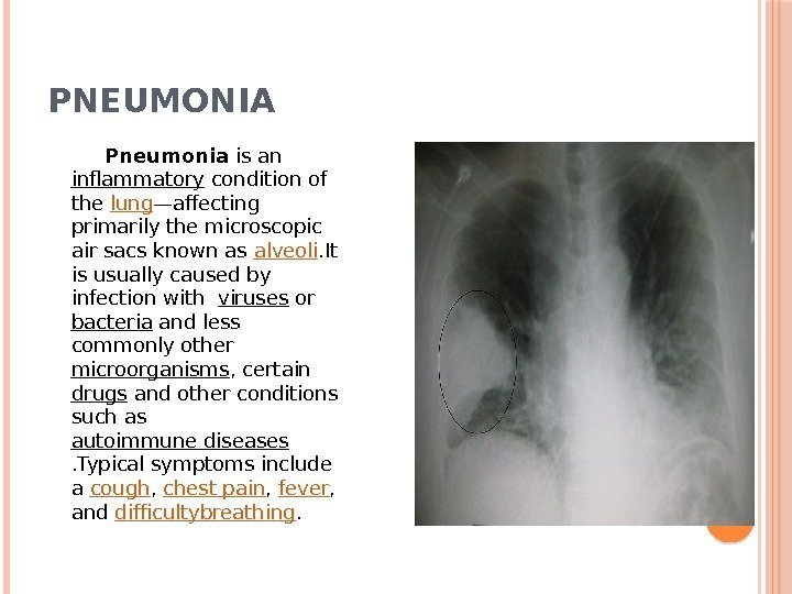PNEUMONIA  Pneumonia is an inflammatory condition of the lung —affecting primarily the microscopic