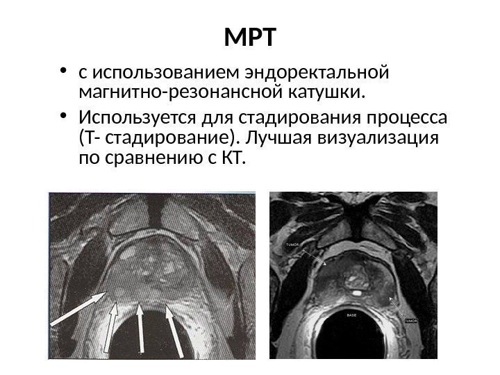 МРТ • с использованием эндоректальной магнитно-резонансной катушки.  • Используется для стадирования процесса (Т-