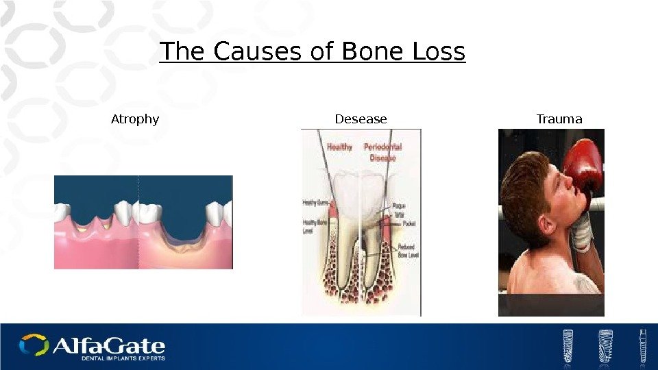 The Causes of Bone Loss Atrophy Trauma. Desease 