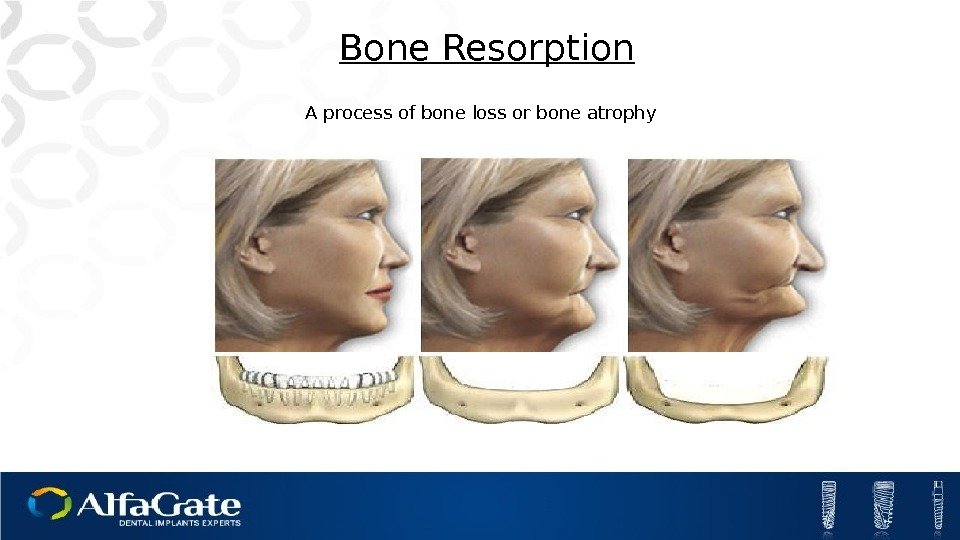 A process of bone loss or bone atrophy Bone Resorption 