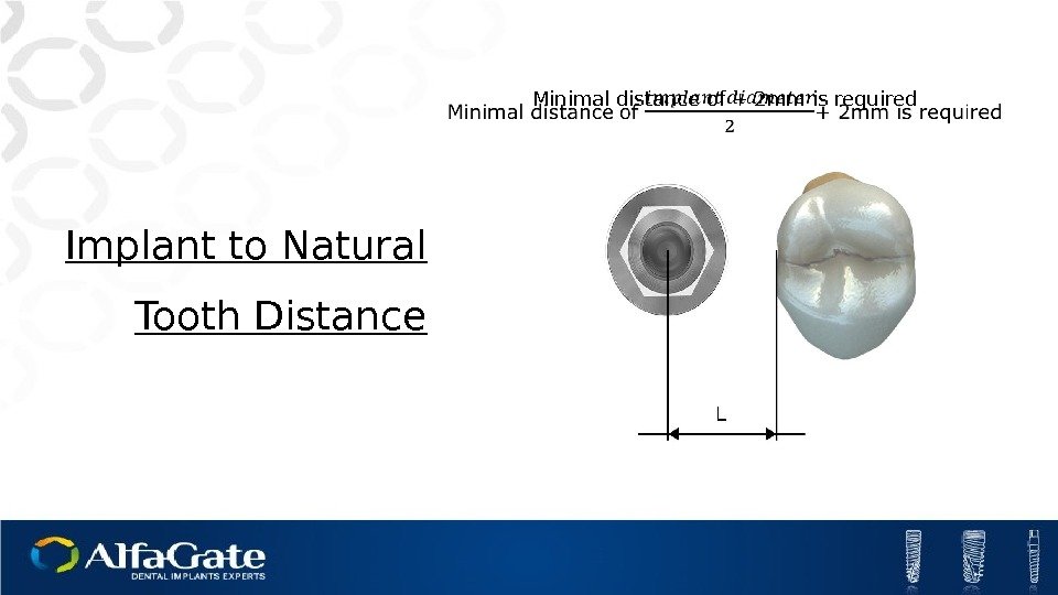 Minimal distance of + 2 mm is required Implant to Natural Tooth Distance 