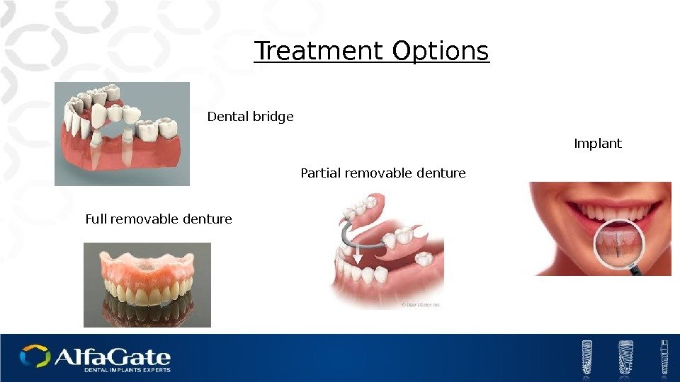 Dental bridge Treatment Options Partial removable denture Full removable denture Implant 