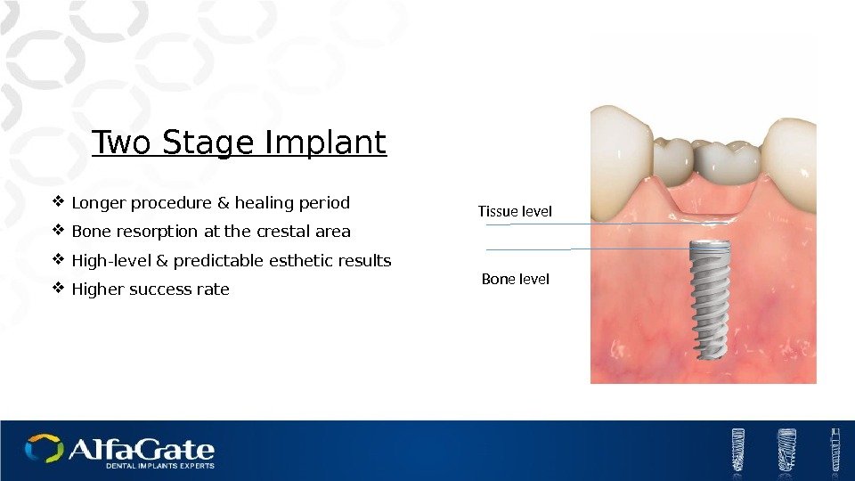 Two Stage Implant Longer procedure & healing period Bone resorption at the crestal area